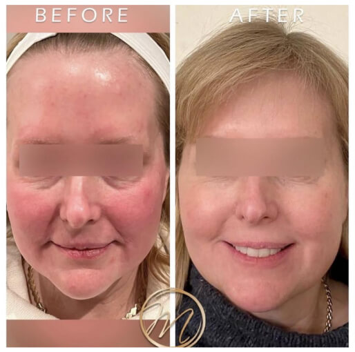 Dermal filler before and after — CosMedic LaserMD patient