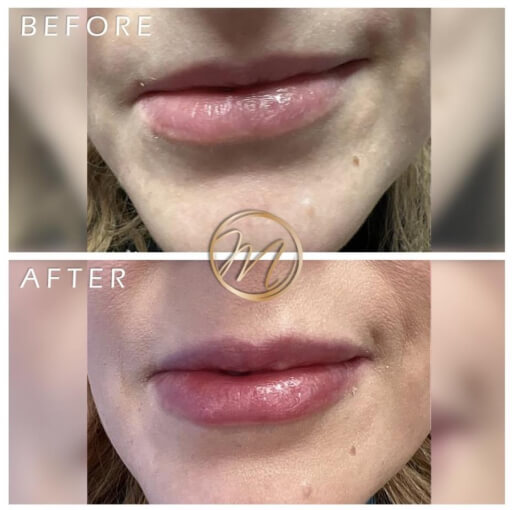 Dermal filler before and after — CosMedic LaserMD patient