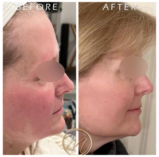 Dermal filler before and after — CosMedic LaserMD patient