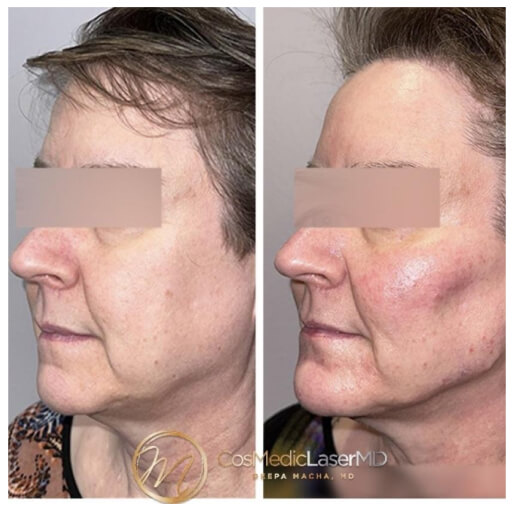 Dermal filler before and after — CosMedic LaserMD patient