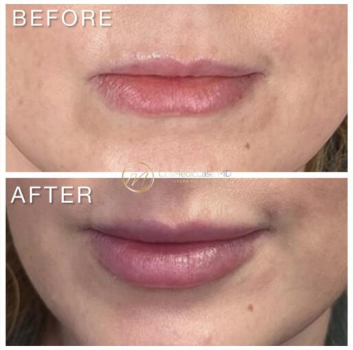 Dermal filler before and after — CosMedic LaserMD patient