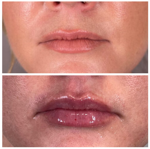 Dermal filler before and after — CosMedic LaserMD patient