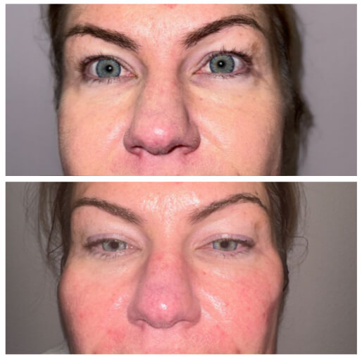 Dermal filler before and after — CosMedic LaserMD patient