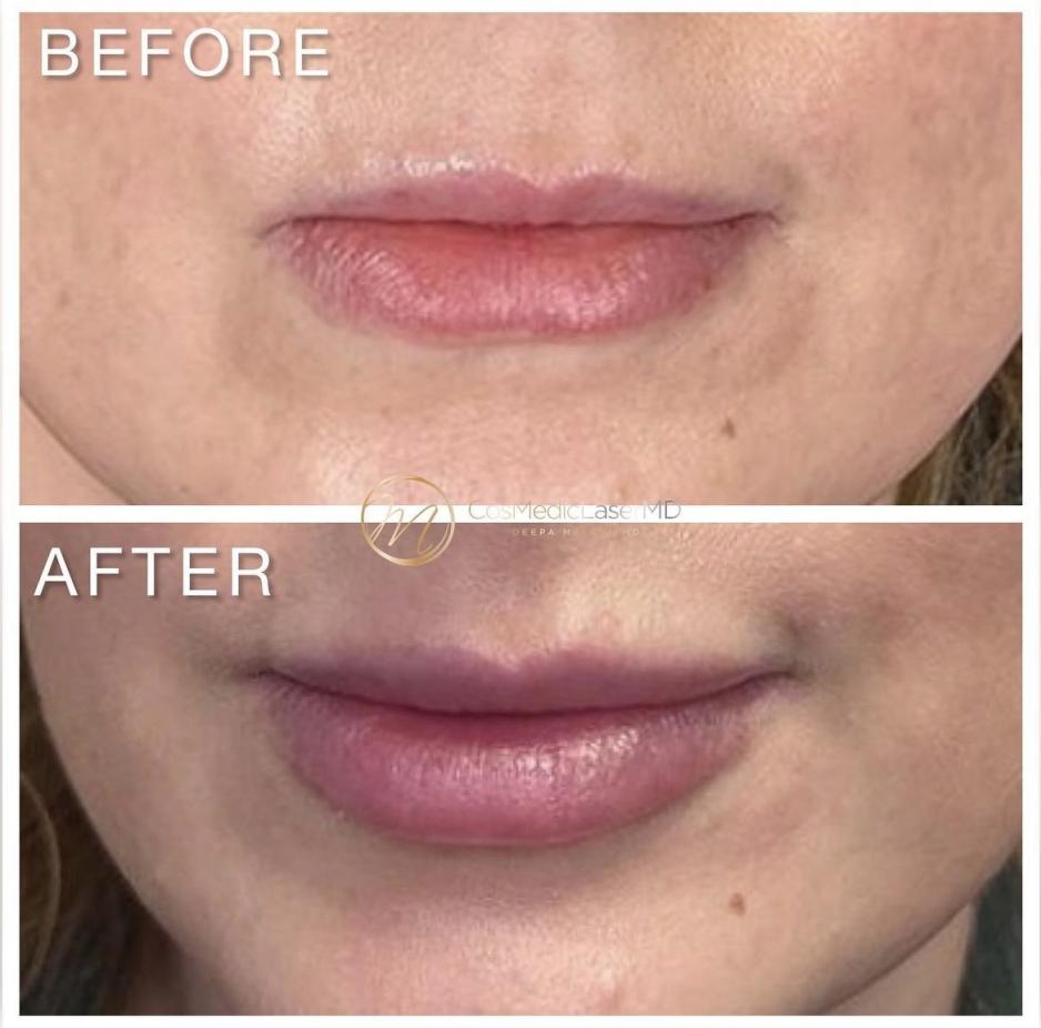 Lip filler before and after — CosMedic LaserMD patient
