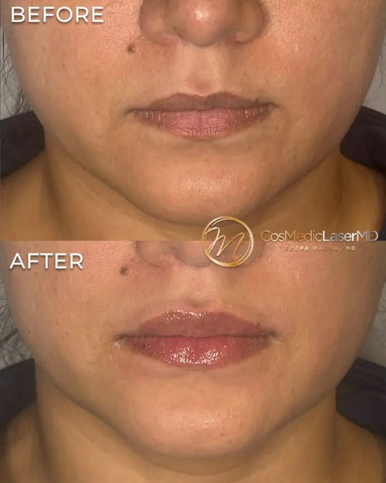 Lip filler before and after — CosMedic LaserMD patient