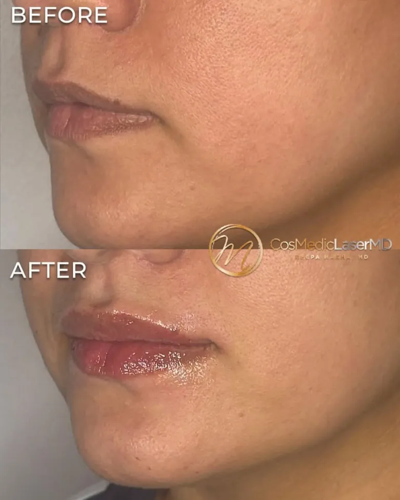 Lip filler before and after — CosMedic LaserMD patient