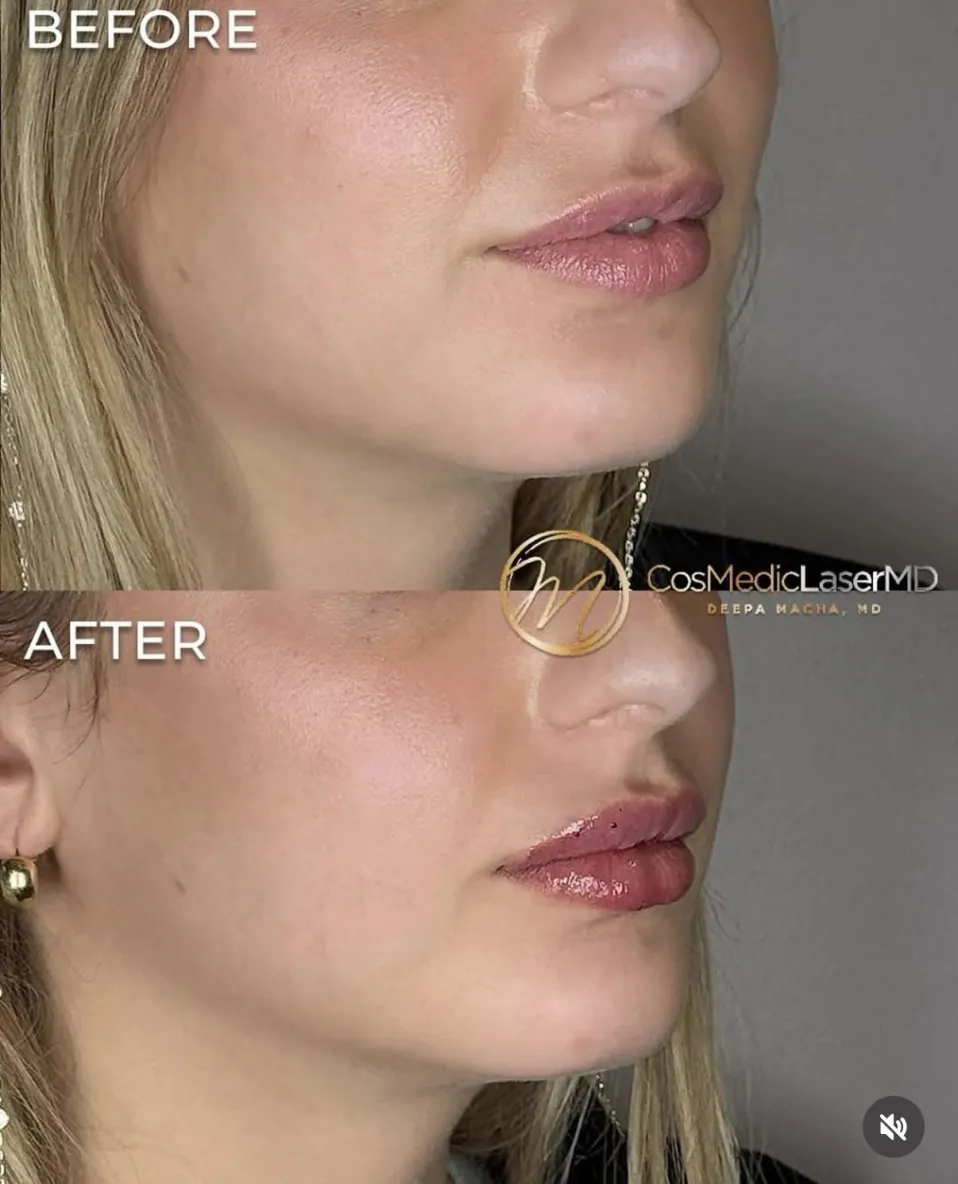 Lip filler before and after — CosMedic LaserMD patient