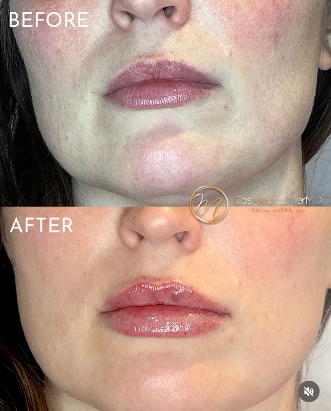 Lip filler before and after — CosMedic LaserMD patient